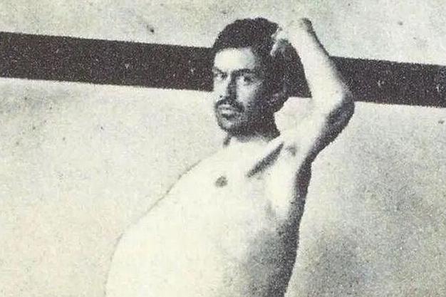 排便|史上被屎憋死的人,3年没上厕所,粪便高达36斤!