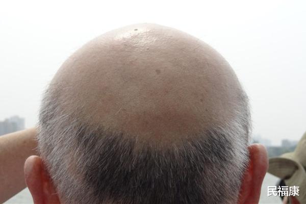 民福康|年纪轻轻就已严重脱发，一起来了解“秃顶”原因
