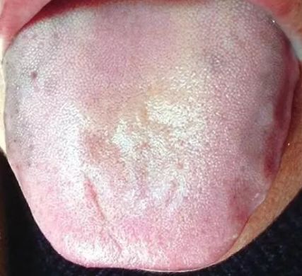 近视|舌头中间有裂纹,或者边缘有齿痕等,是『大病征兆』?现在知道还不晚!