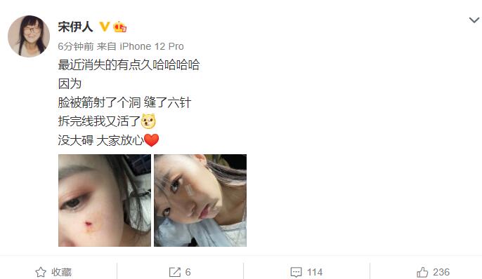 陈飞宇|曾与陈飞宇拍过戏的宋伊人脸被箭射个洞,缝了六针,近照皮肤真好