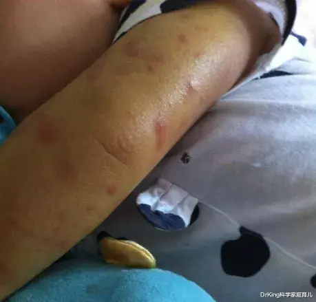 DrKing科学家庭育儿|触目惊心！蚊子传染19006例登革热，秋季严防这种“毒蚊”！