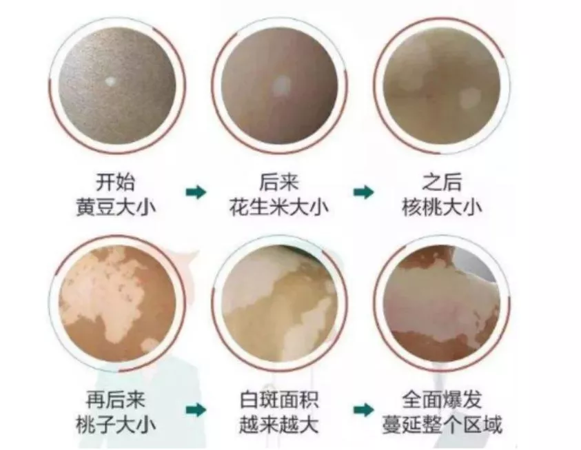 黑色素|@白癜风患者 邀请你走进黑色素的世界！