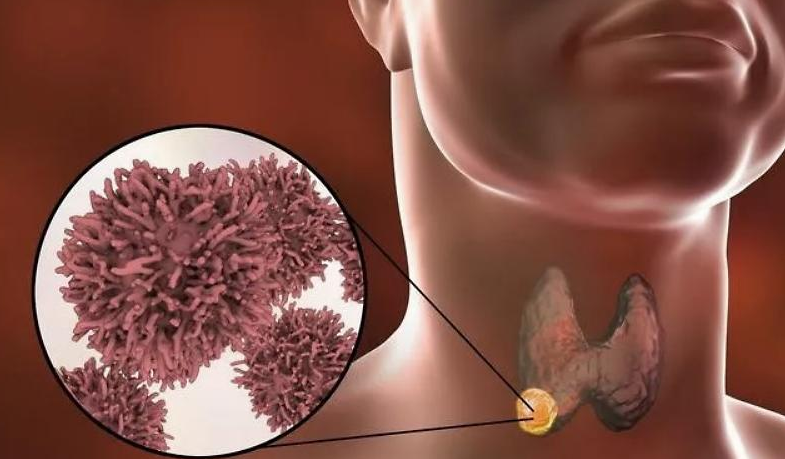 鸡蛋|甲状腺结节不能吃鸡蛋?医生提醒:除鸡蛋外,2种食物也不可多吃