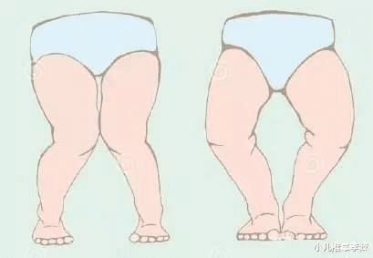 小儿推拿李波|小儿推拿李波：宝宝罗圈腿是怎么回事？怎样预防纠正？常见误区？