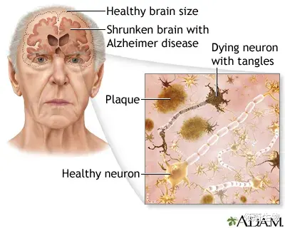 空间站 顶刊连发：炎症因子可预防阿尔茨海默病！