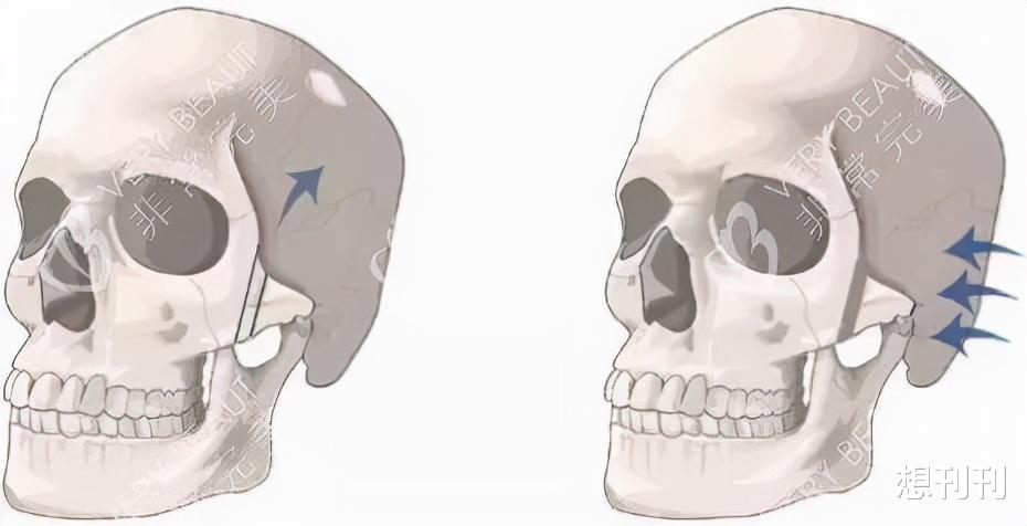 后遗症|做了颧骨内推的明星真的变美了吗?推平容易后悔难,后遗症一大堆