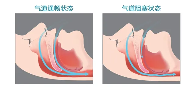 BMC怡和嘉业|为什么岁数大了更容易打呼噜？
