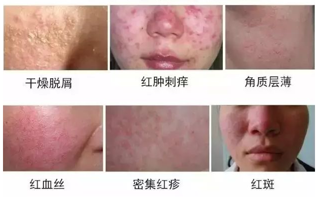 钻戒 秋冬季敏感肌肤的八种状态，错误的护肤方式，伤害了多少少女心