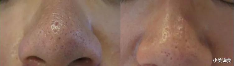 刷酸和光子联合的好，真的能有磨皮软件的效果