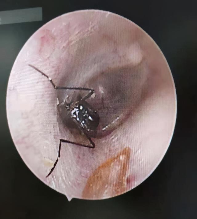 杭州24小时 太可怕，一女子耳朵里取出蜘蛛，折磨一晚！医生说，异物入耳这么做