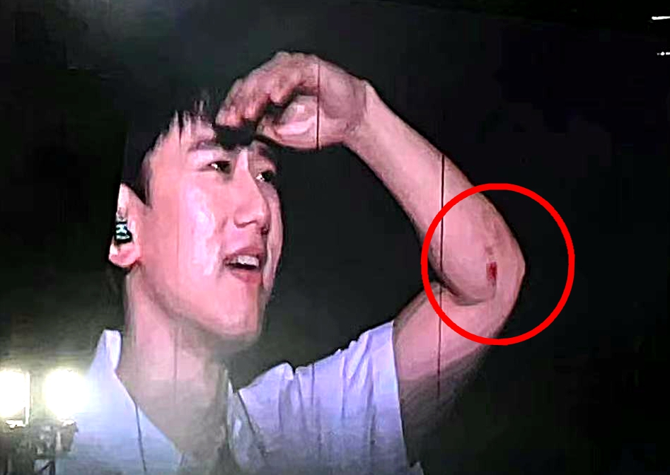 张杰|工作室公布张杰伤势，手指伤口已缝合，腰部骨裂将暂停舞蹈表演