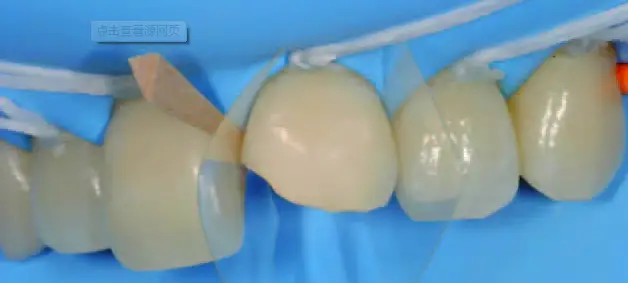 牙齿|常见的补牙材料带你来了解一下~
