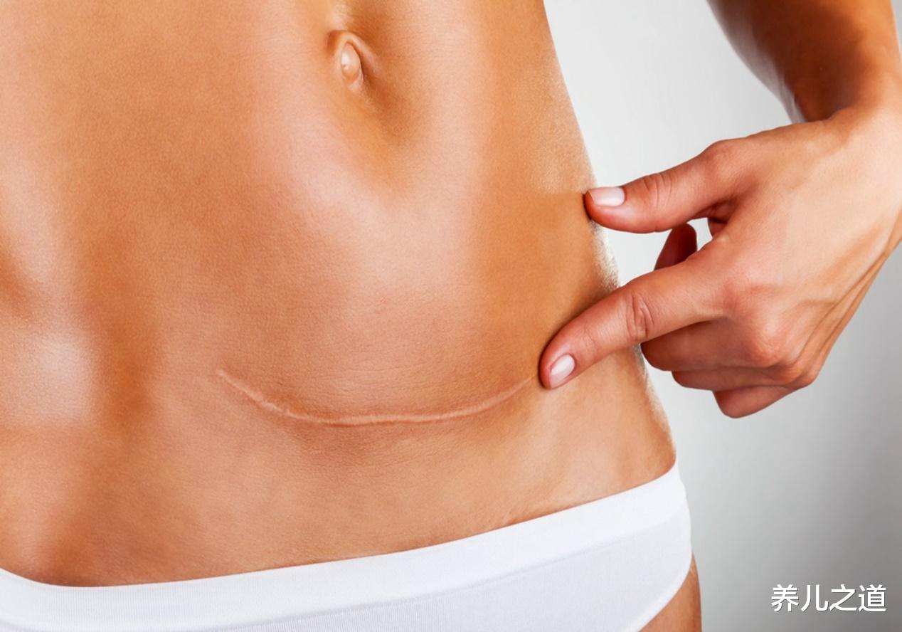 甲状腺结节|明明不是“疤痕体质”，但剖腹产后却很明显，说明与三点原因有关