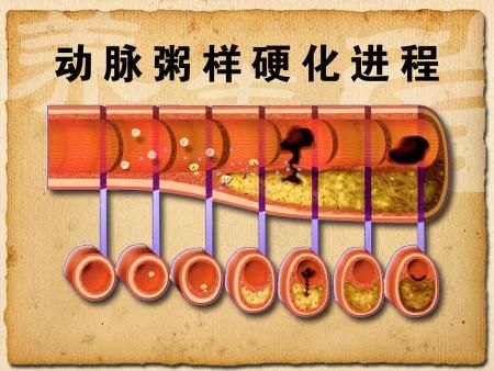 丹参|食物能软化血管？不要被骗了！软化血管在于控“酸”，遵循3原则