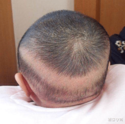 喜芽孕育|枕秃≠缺钙
