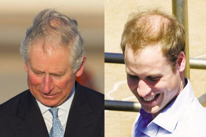 為什麼威廉王子已經禿頂而哈裡王子卻還擁有一頭濃密的頭發呢？-圖5