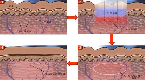 樱桃妈咪|产后能完全祛除妊娠纹？医生：不可能！但可以试试这3个淡化妙招