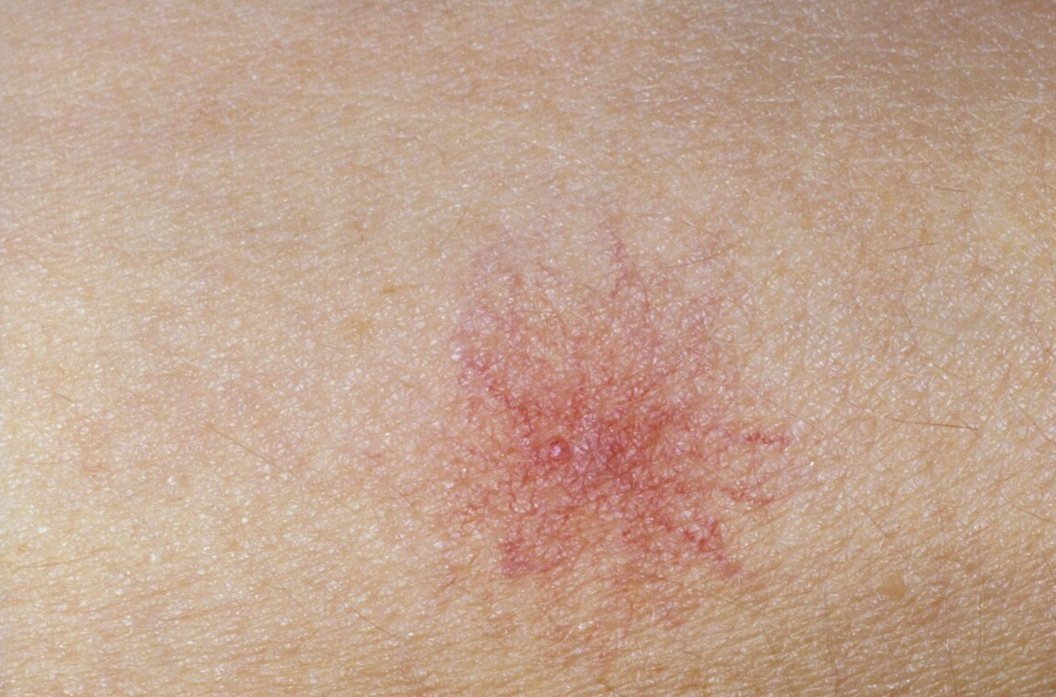 过敏|误认为皮肤过敏，查出肝癌！提醒：皮肤3种异常，肝或已“烂如蜂窝”