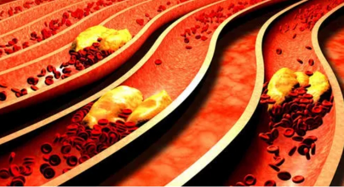 雪雪的鱼|3种食物是“升脂大户”，医生提醒：血脂高的人，劝你尽量少吃