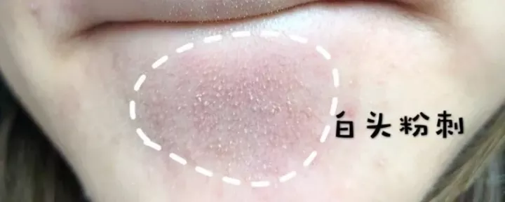 萌萌一笔 闭口痘痘会自己好吗