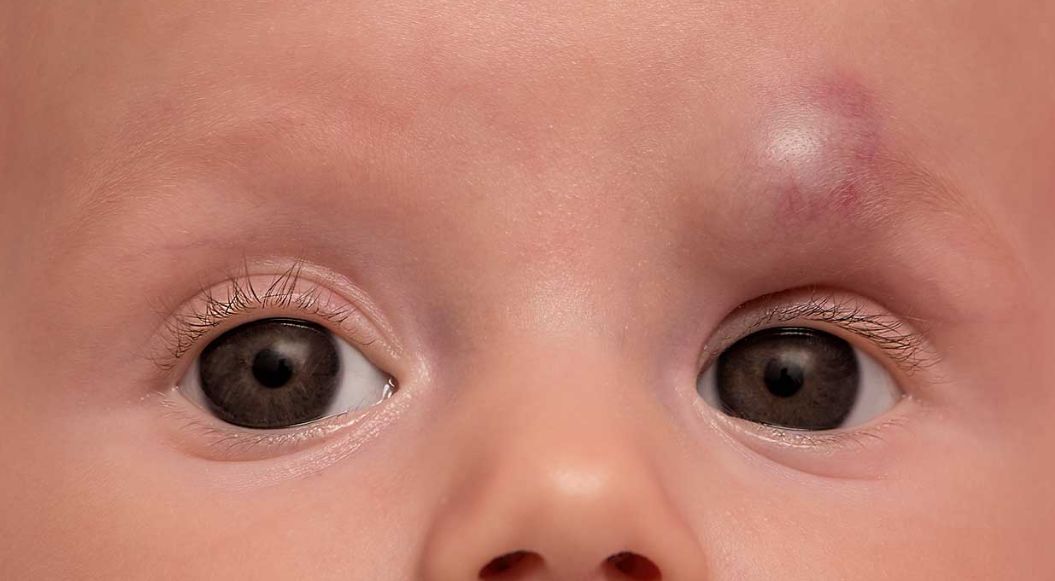 亚西亚健康网|宝宝的身上小血包，要分清是斑痣还是血管瘤