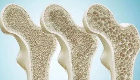 幽门螺杆菌|茄子是骨质疏松的“发物”？医生：若想骨头好，3物劝你少吃