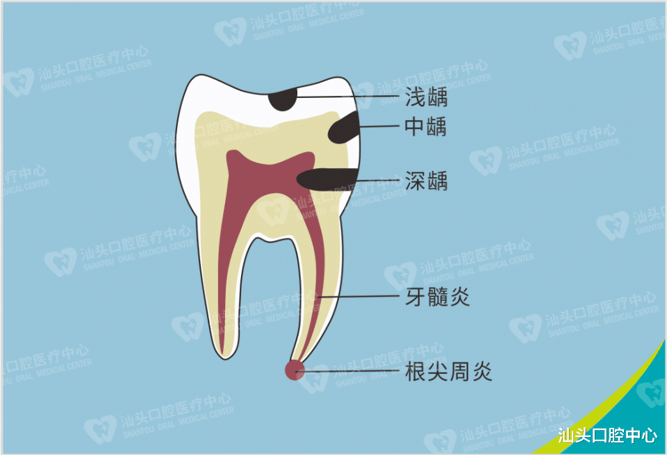 汕头口腔中心 为什么死髓牙会变颜色？有什么危害吗？看看如何处理