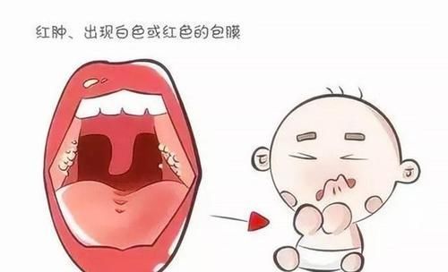 海绵宝宝会唱歌|急性扁桃体炎的护理和危害有哪些