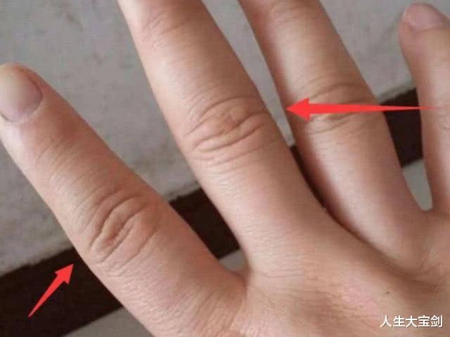 |如果男生的肾功能不好,一般手上有这三个标志,如果发现就要节制