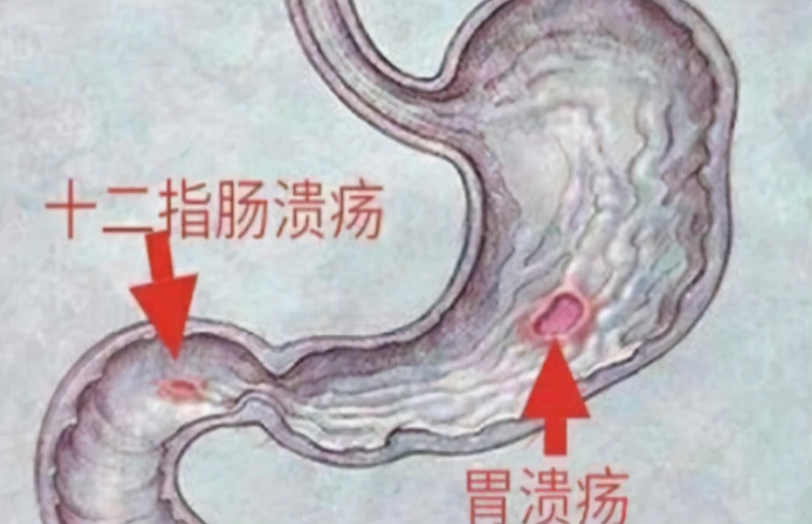 金兰中医学社 胃不好的人，身体多会表现3反常，常吃“2物”，养胃通便，灭口臭