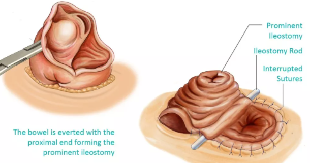 直肠癌|真的有人没肛门？那怎么生活？你可能从未听闻，低位直肠癌的彷徨