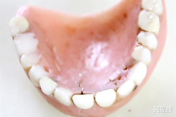 牙齿|中老年人出现牙齿松动,掉牙是正常生理现象吗?