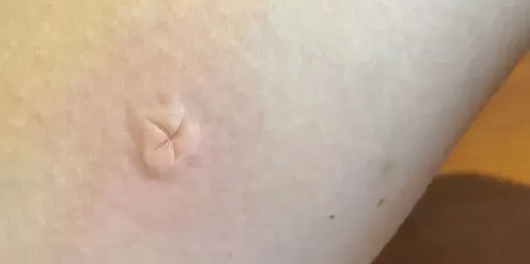 蚊子 为什么你总被蚊子叮上？学会这些招，蚊子转身咬别人