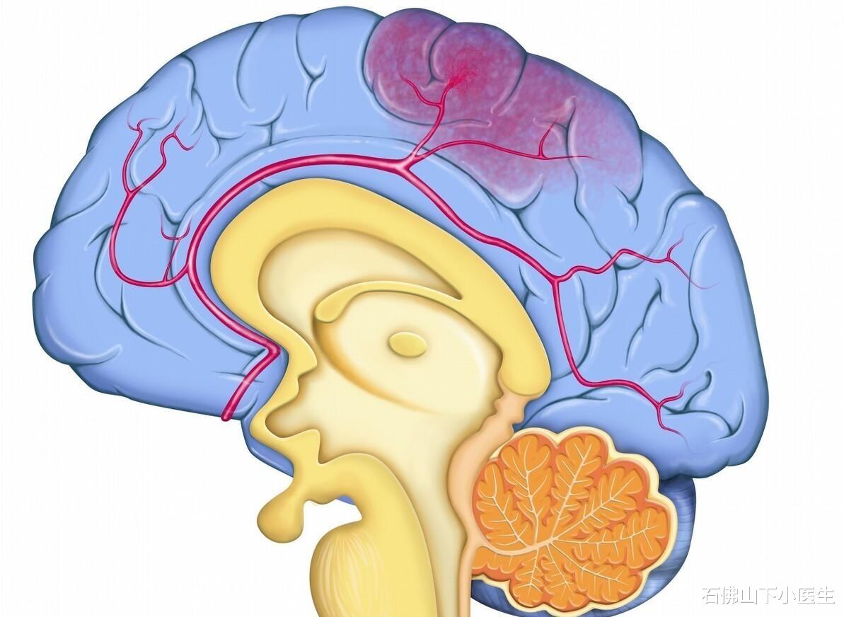 石佛山下小医生|脑出血来临，身体有什么症状？哪些人更容易发生脑出血？