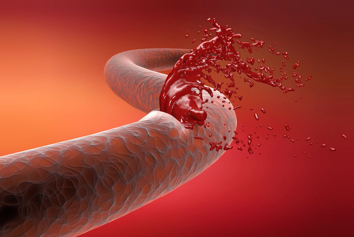 肺癌|咯血10年再加重，2小时咳一茶杯，病人大喊救命，一根导丝立止血