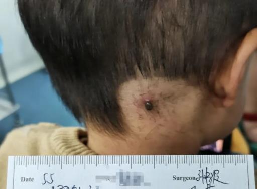 我是妈妈|4岁孩子被蜱虫咬伤，宝妈一番操作救了娃，获得医生连连称赞