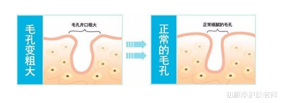 发型 “毛孔粗大”怎么办？确定类型、对症解决，才能有效收缩毛孔！