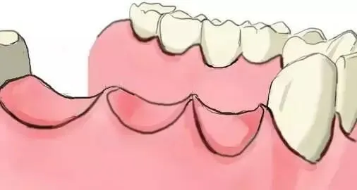 牙齿|镶假牙的这些坑，你千万别踩