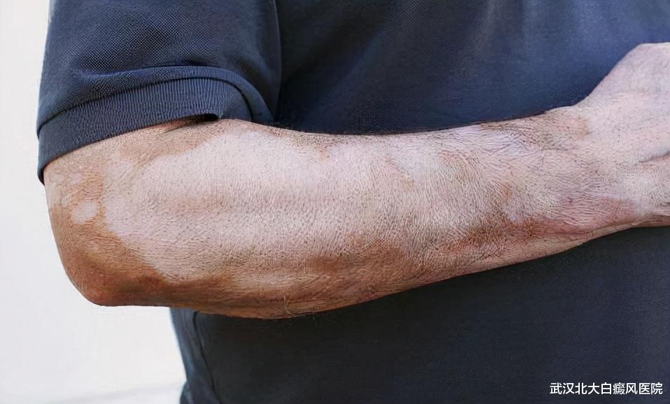 白癜风|男性白癜风快速扩散是什么原因?该怎么办?