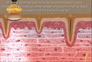 运动|“护肤神器”会“毁容”，盲目跟风购买美容仪后，网友：追悔莫及