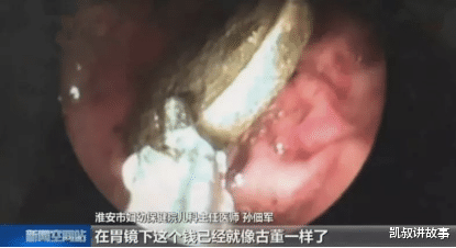 凯叔讲故事 男孩吃饺子吞下2枚硬币，一年后取出，家里这些小物件一定要注意