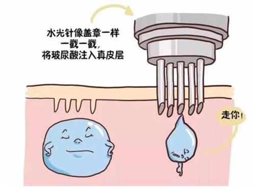 小玉护肤|深度剖析：水光针和长痘之间的某些关联因素!