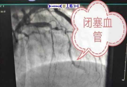 长寿|44岁男性1年努力，心血管狭窄70%逆转成50%，如何做到的？