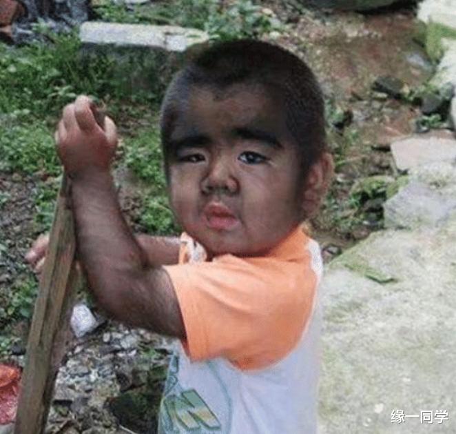 缘一同学 当年轰动全国的“中国第一毛孩”，被人当成怪物，后来怎样了？