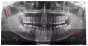 运动|牙科X光真的很有用！