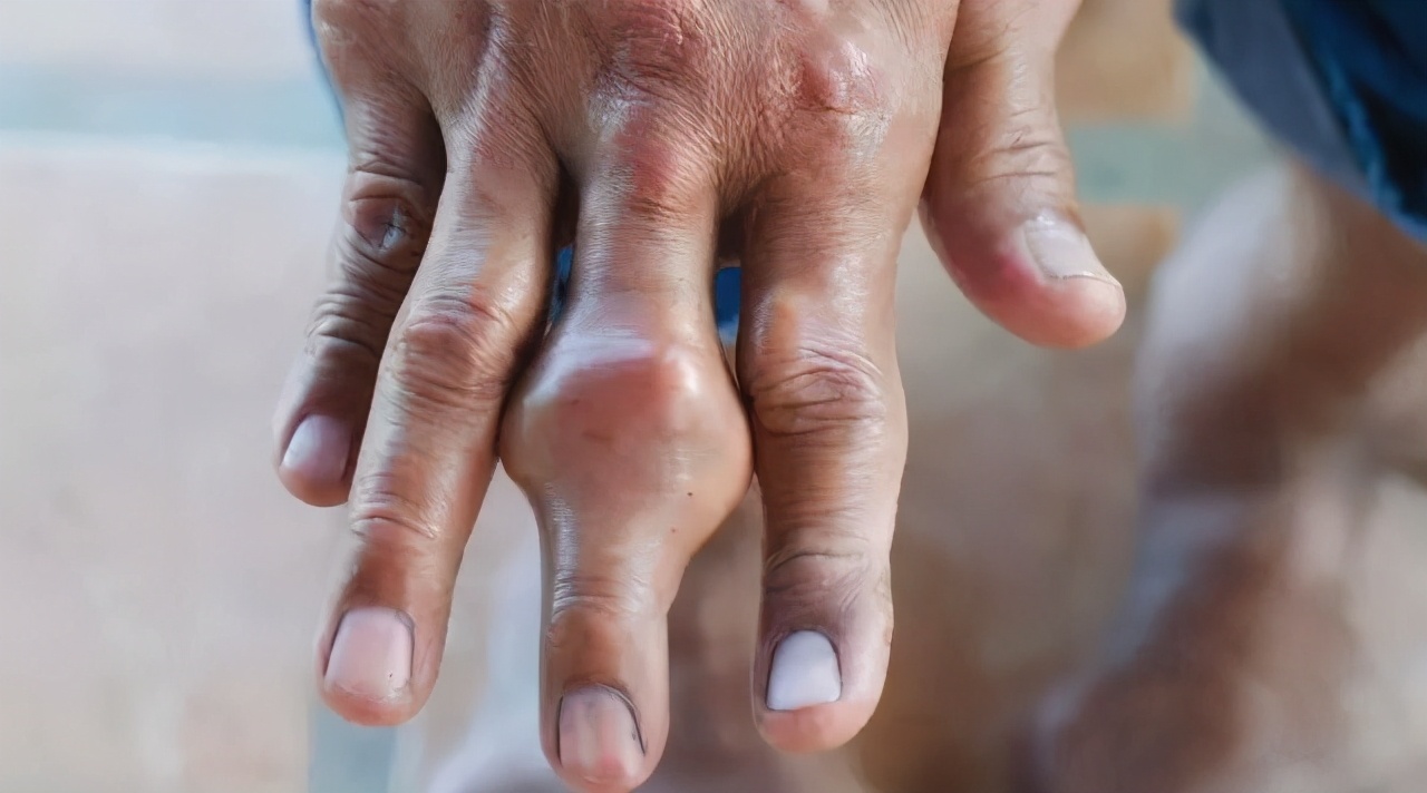 高尿酸血症|高尿酸血症,没症状!不痛不痒更可怕!避免食用的食物有哪些?