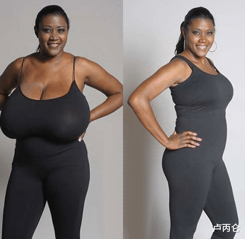 卢丙仑 胸部特别大?别骄傲,可能是一种病