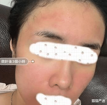 黑色素 还在走捷径打美容针？看看这些反面例子长点心吧！护肤这事急不得