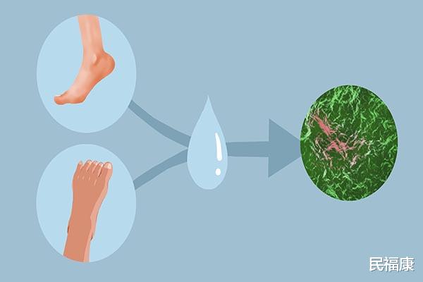 脚气|经常脚痒，就是得了脚气吗？用醋泡脚管用？脚痒的人不妨早点看