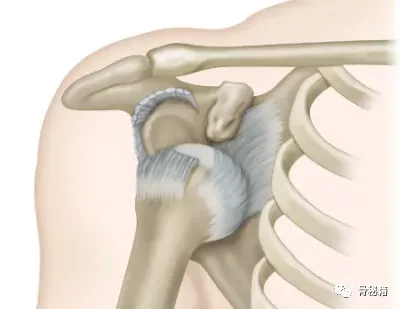 关节脱位|老年肩关节脱位的处理,推荐都看看